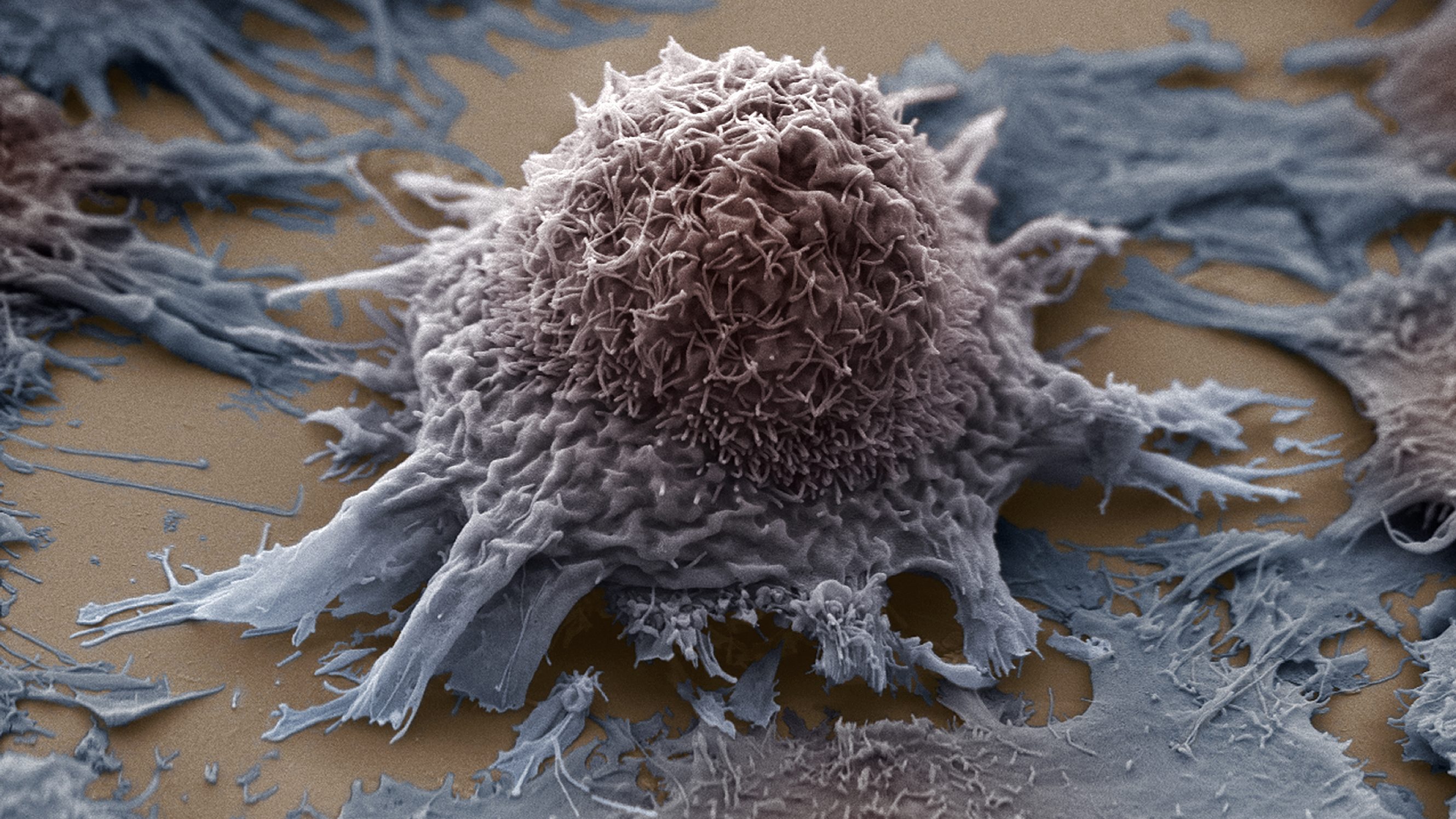 Lung cancer cell, SEM X3500. (Getty Images)