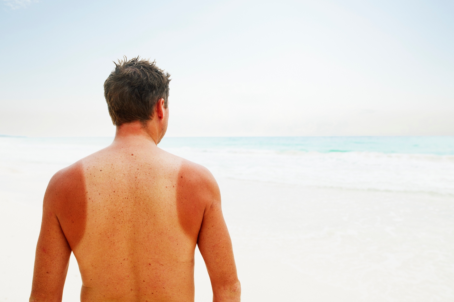 Man with sun burn standing near water on tropical beach rear view